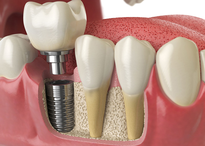 Implant Dentistry in Turkey
